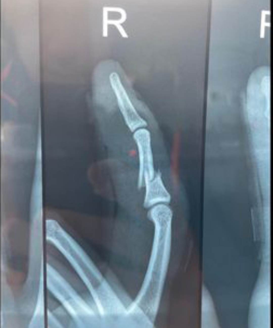Cameron Green Finger X-RAY